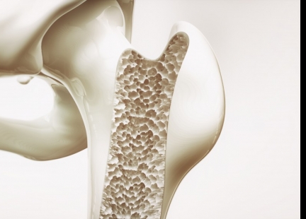 Osteoporoza – poznaj cichego wroga