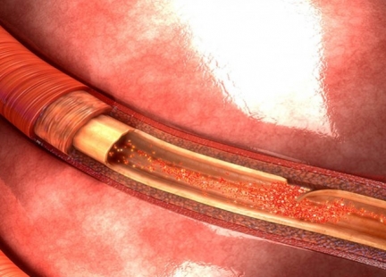 Tętniak aorty 