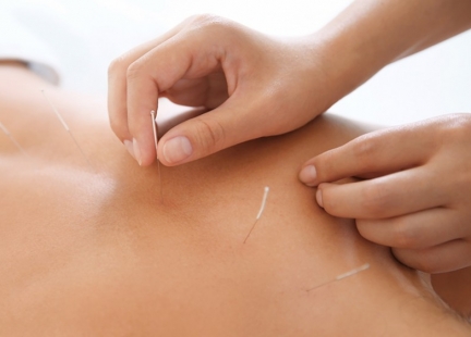 Akupunktura – w czym może pomóc