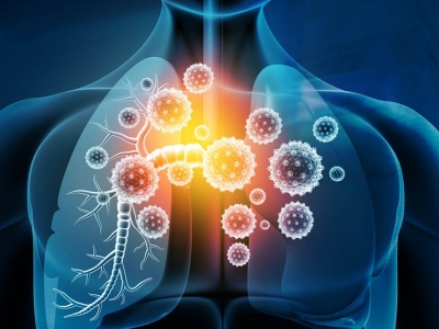 Alergiczne zapalenie pęcherzyków płucnych
