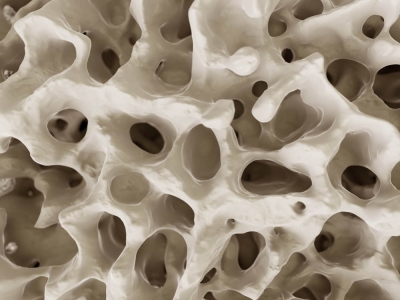 Osteoporoza – cichy zabójca Polaków
